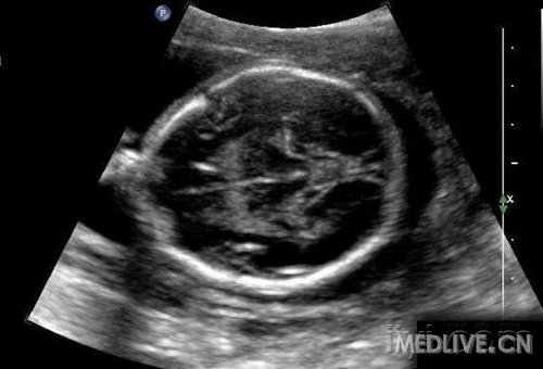 准妈妈看过来孕期瑜伽,孕期b超知识大全