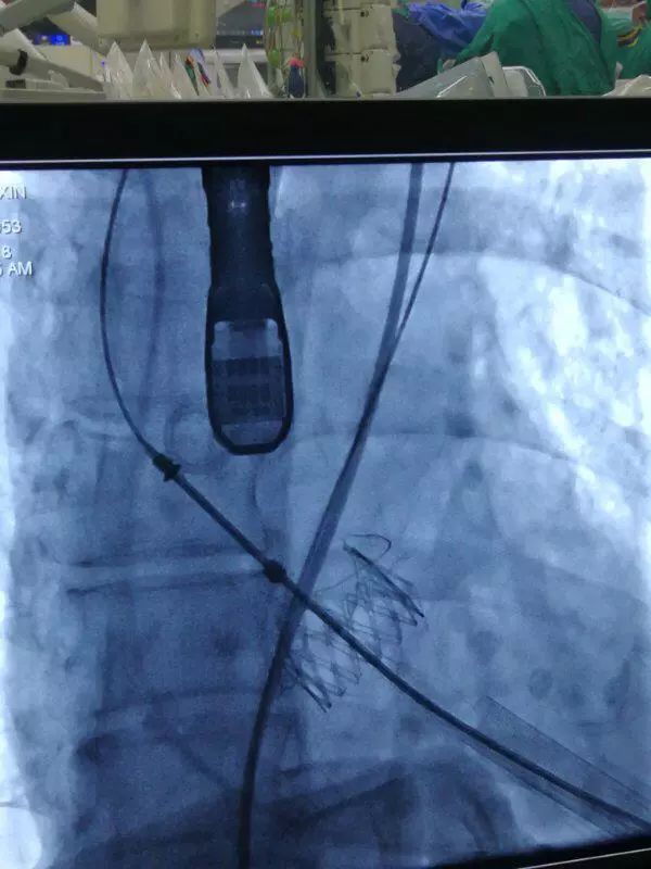 微新闻｜心脏“阀门”关不紧，专家妙手装“新门”——华南中医系统首例！广东省中医院完成经心尖微创主动脉瓣置入术（TAVI）