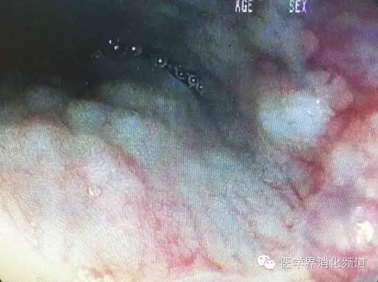 barrett食管的症状是什么,barrett食管是什么意思