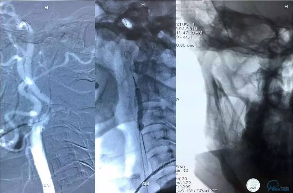 脑动脉瘤并颈动脉狭窄怎么治疗,脑动脉血管狭窄介入治疗效果好吗