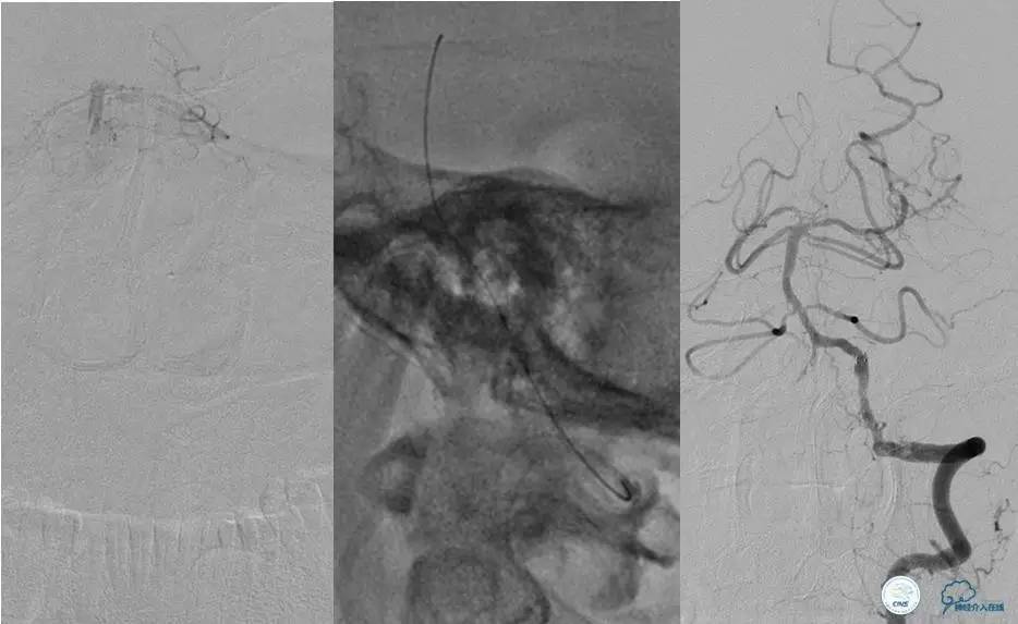 颅内动脉狭窄介入治疗研究,颅内血管cta副作用