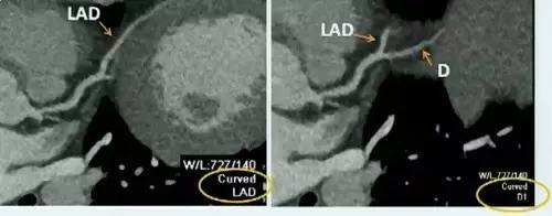 微课堂牢记三要诀，轻松看懂冠脉CTA