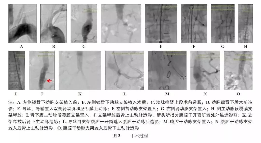 evar手术,胸主动脉夹层开窗手术