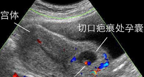 孕期出血,是自然流产吗?