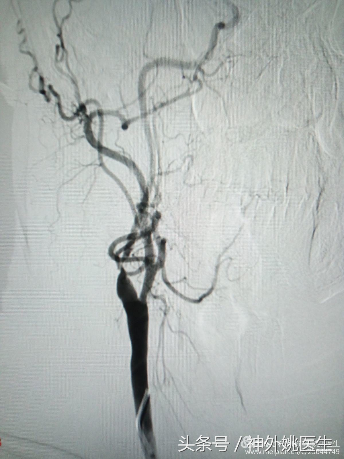 颈内动脉狭窄可以做内膜剥脱术吗,颈内动脉内膜剥脱手术指征