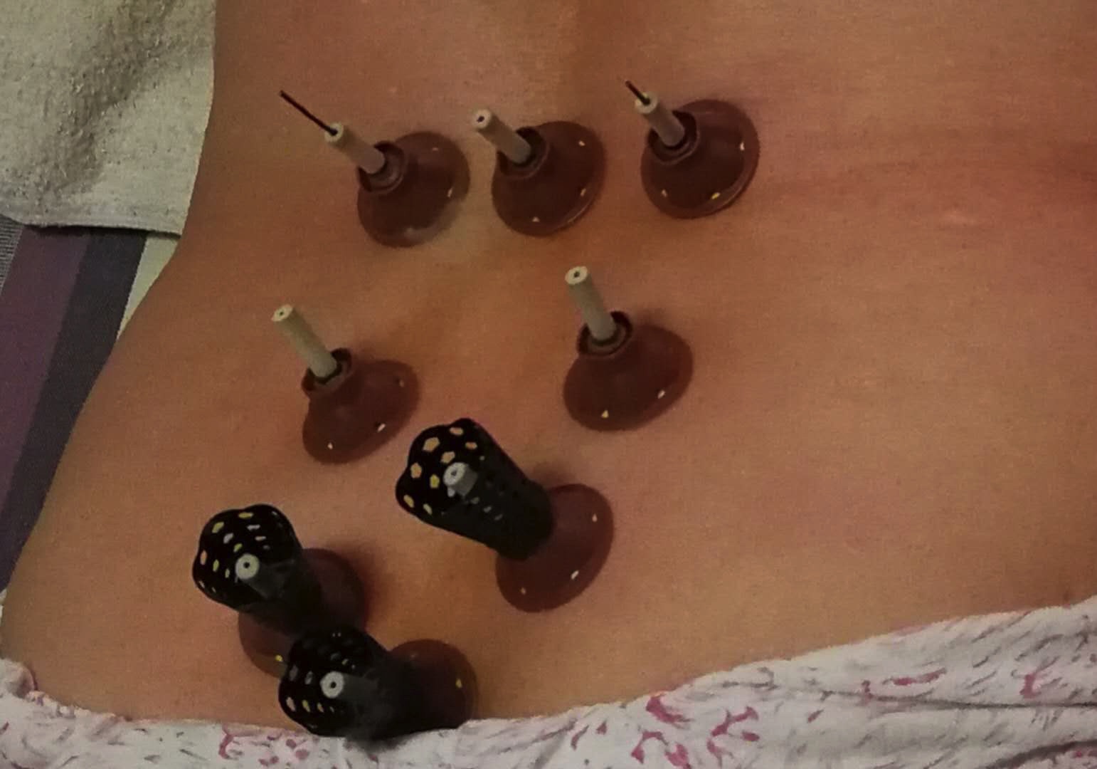 平衡疗法治疗腰腿疼,经方治疗椎间盘突出医案