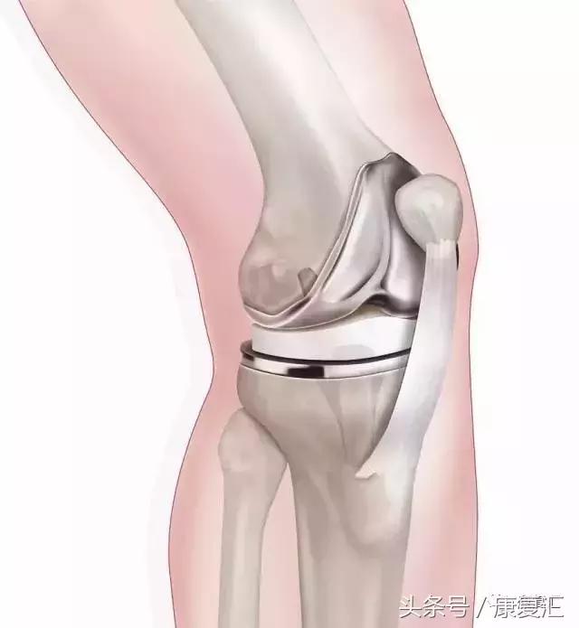 膝关节骨关节炎诊治的十大误区,膝关节炎警惕这些误区