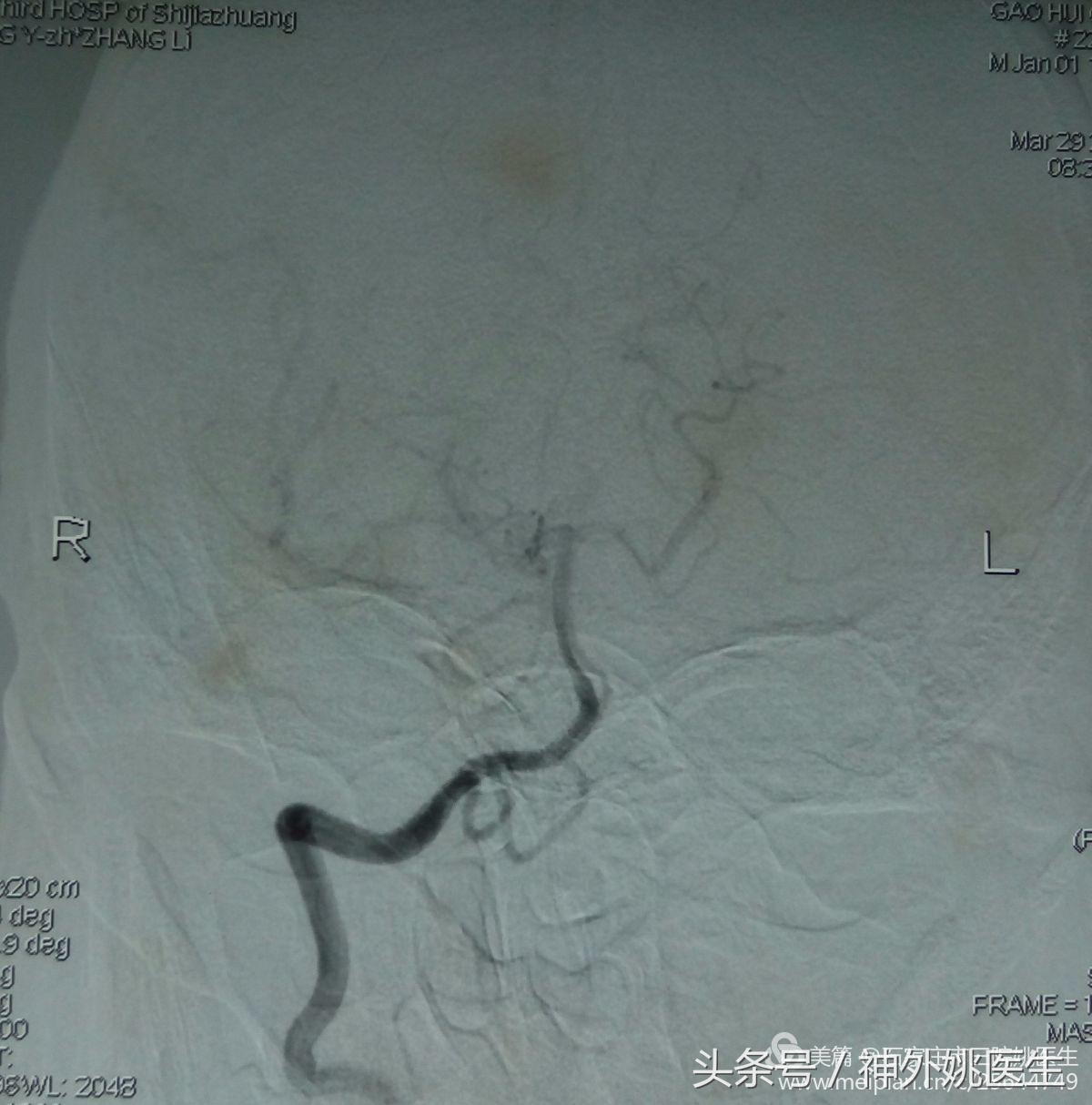 颈内动脉狭窄可以做内膜剥脱术吗,颈内动脉内膜剥脱手术指征