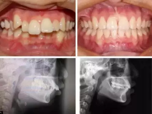 戴牙套为什么要戴橡皮筋要带多久,戴牙套为什么牙齿会长一点