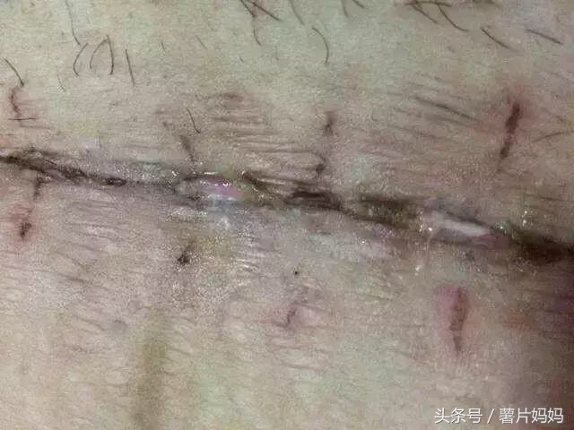 剖腹产30天了伤口裂开怎么办,剖腹产70多天流黄水怎么回事