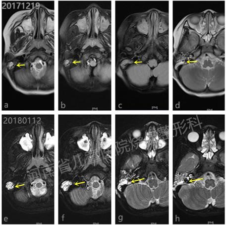 耳后的“血包“——神经外科医生巧判断，多学科会诊解难题