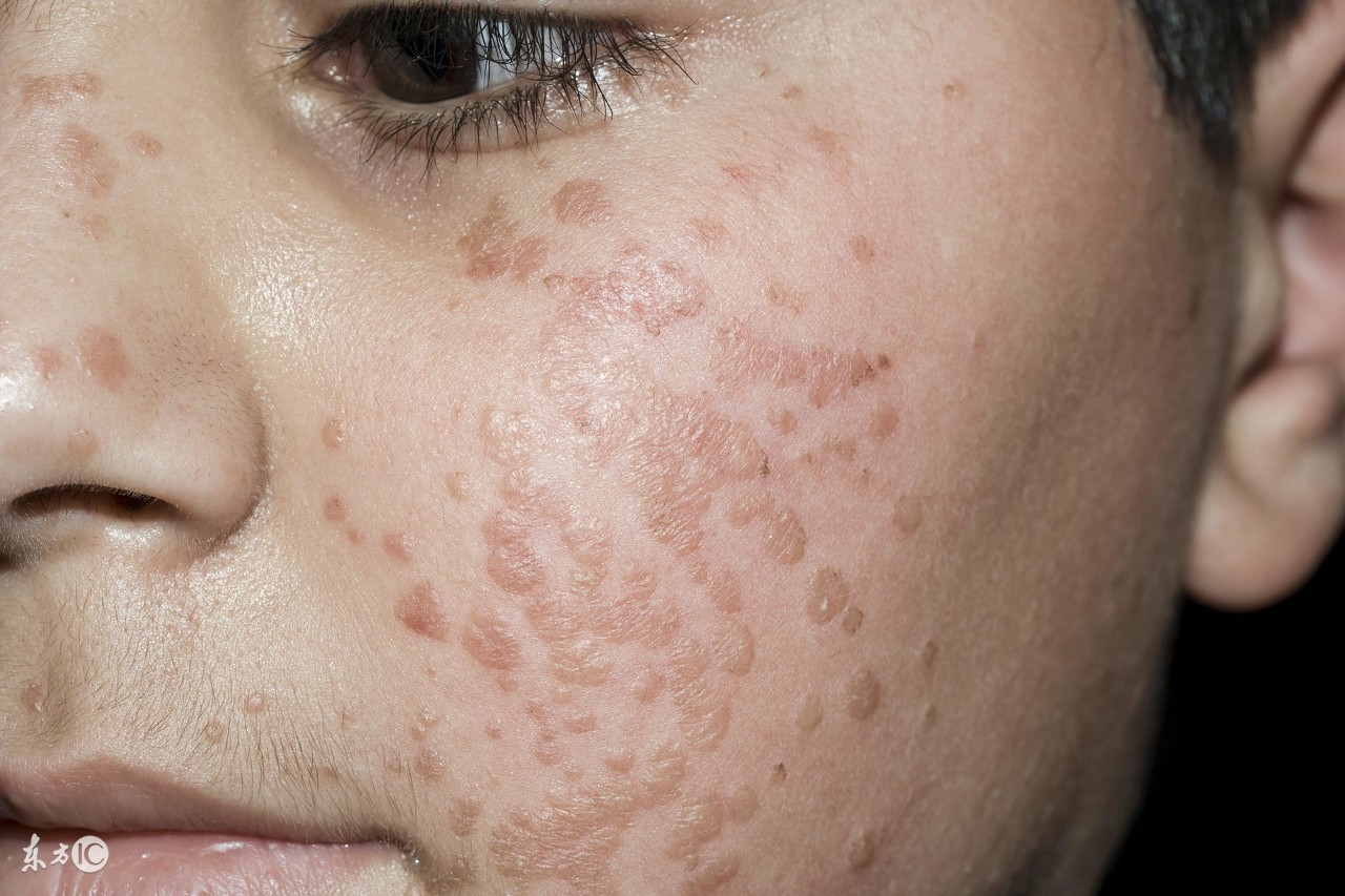 分析扁平疣突然很痒的原因以及扁平疣痒时该怎么办