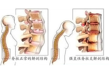 强直性脊柱炎的临床诊断,强直性脊柱炎诊断标准与治疗