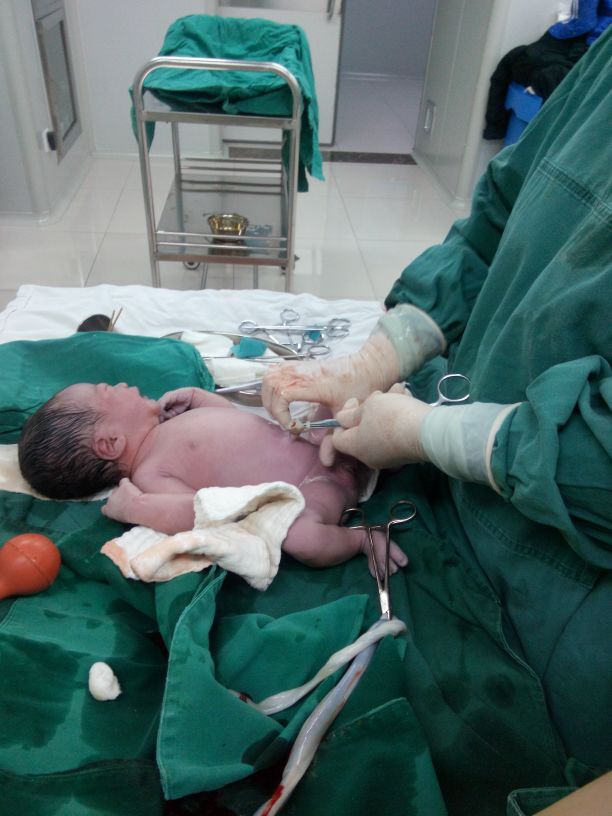 羊水偏少脐带绕颈2周能顺产吗,羊水偏少就必须剖腹产吗