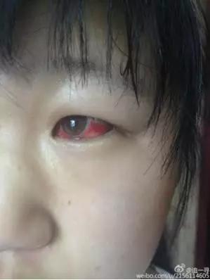 孩子在学校甲醛中毒怎么办,学校甲醛中毒科普视频