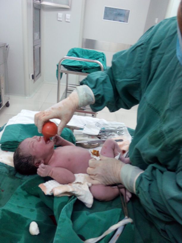 羊水偏少脐带绕颈2周能顺产吗,羊水偏少就必须剖腹产吗