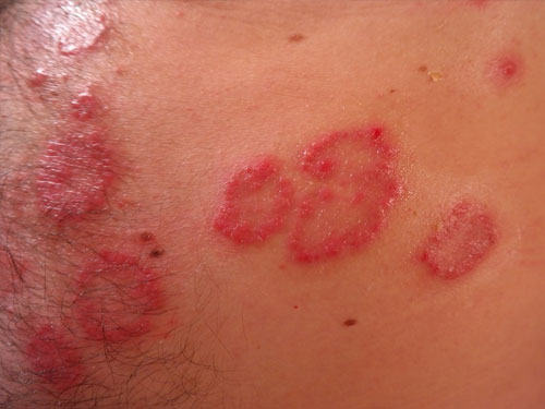 摆脱湿疹的小方法,湿疹的天敌居然是它