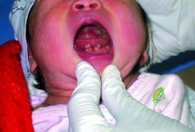 新生儿嘴巴长牙齿,刚出生的宝宝嘴里长马牙怎么办