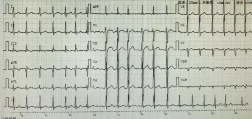 郑大一附院心血管内科专家陈英伟,房颤的治疗策略及进展