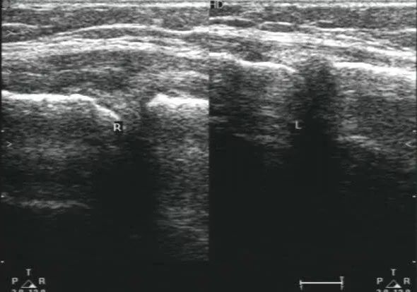 超声提示不发育了怎么回事呢,超声检查不硬咋办