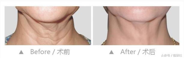 温顺谦和大妈修炼计——扼制颈部老化