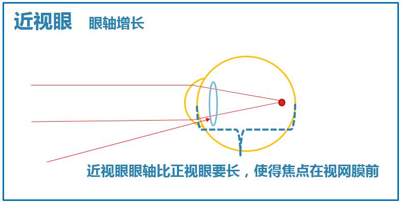 近视后有什么方法可以缓解近视,如何在短时间内恢复近视