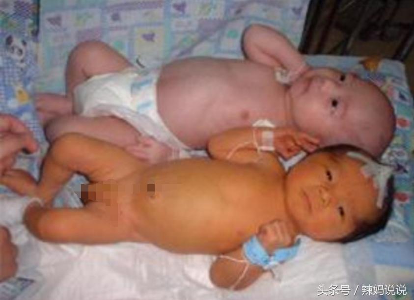 黄疸皮肤黄怎么办,宝宝黄疸退了皮肤为什么还是黄