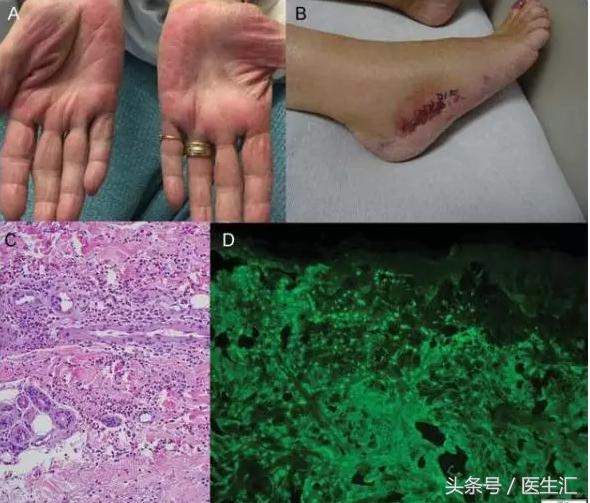 末端神经病变症状,糖尿病神经末梢病变怎么解决