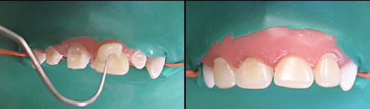 乳前牙预成冠补牙过程,乳前牙龋坏修复