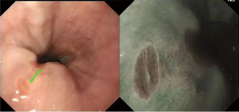 常见的内镜染色方法原理、内镜下表现