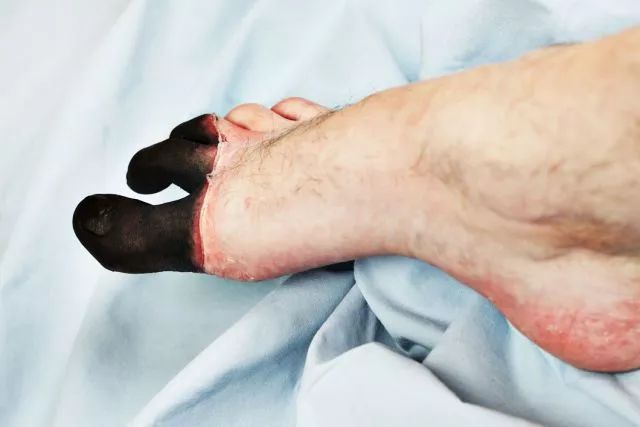 冻伤怎么自救互救,失温冻伤如何自救