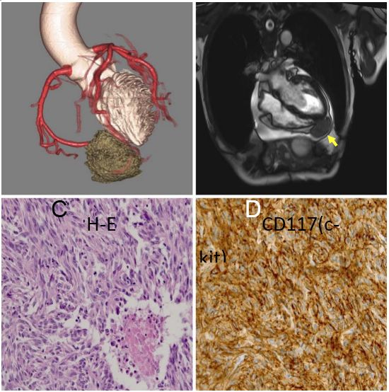 PubmedGIST文献月评第十四期(Jan.2018)