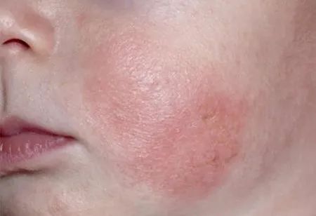 宝宝湿疹最实用的解决方法,治疗婴儿湿疹三个立竿见影的理念