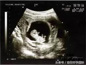 孕5-6周早期少量出血不要紧张,孕6周早期出血