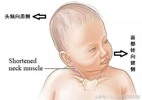 哈尔滨小儿推拿斜颈哪个地方好,小儿斜颈推拿的治愈率有多高