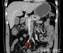 呕吐出褐色的液体,呕吐出咖啡色絮状物需要去医院吗