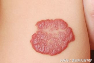 婴幼儿血管瘤常见的治疗方法,婴幼儿血管瘤的治疗方法