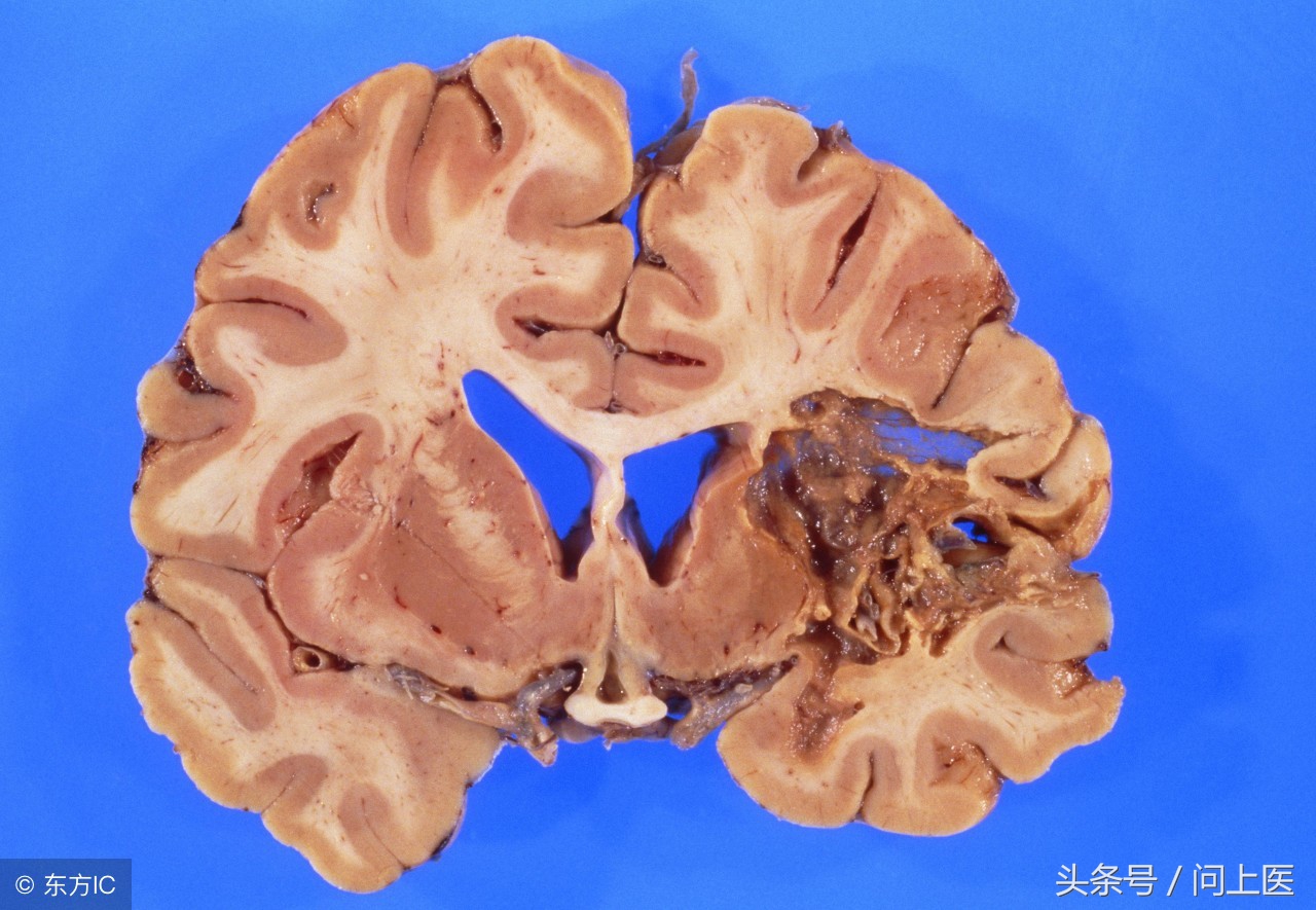 预防脑中风可以吃阿司匹林吗,吃他汀和阿司匹林能预防脑中风吗