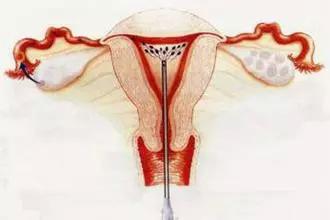 绝经后,子宫也会给你发出“警报”