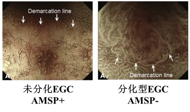 内镜检查痛苦吗,内镜检查是怎么做的