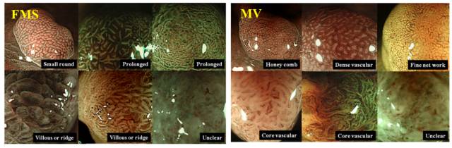 内镜检查痛苦吗,内镜检查是怎么做的