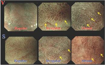 内镜检查痛苦吗,内镜检查是怎么做的