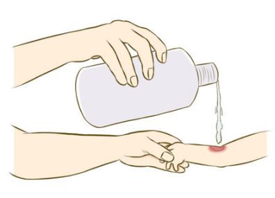 疼！家长们注意：熊孩子这样玩，钢丝刺穿右手中指！