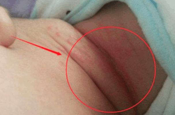 1岁宝宝脖子有黑点点,1岁宝宝脖子有红色斑块