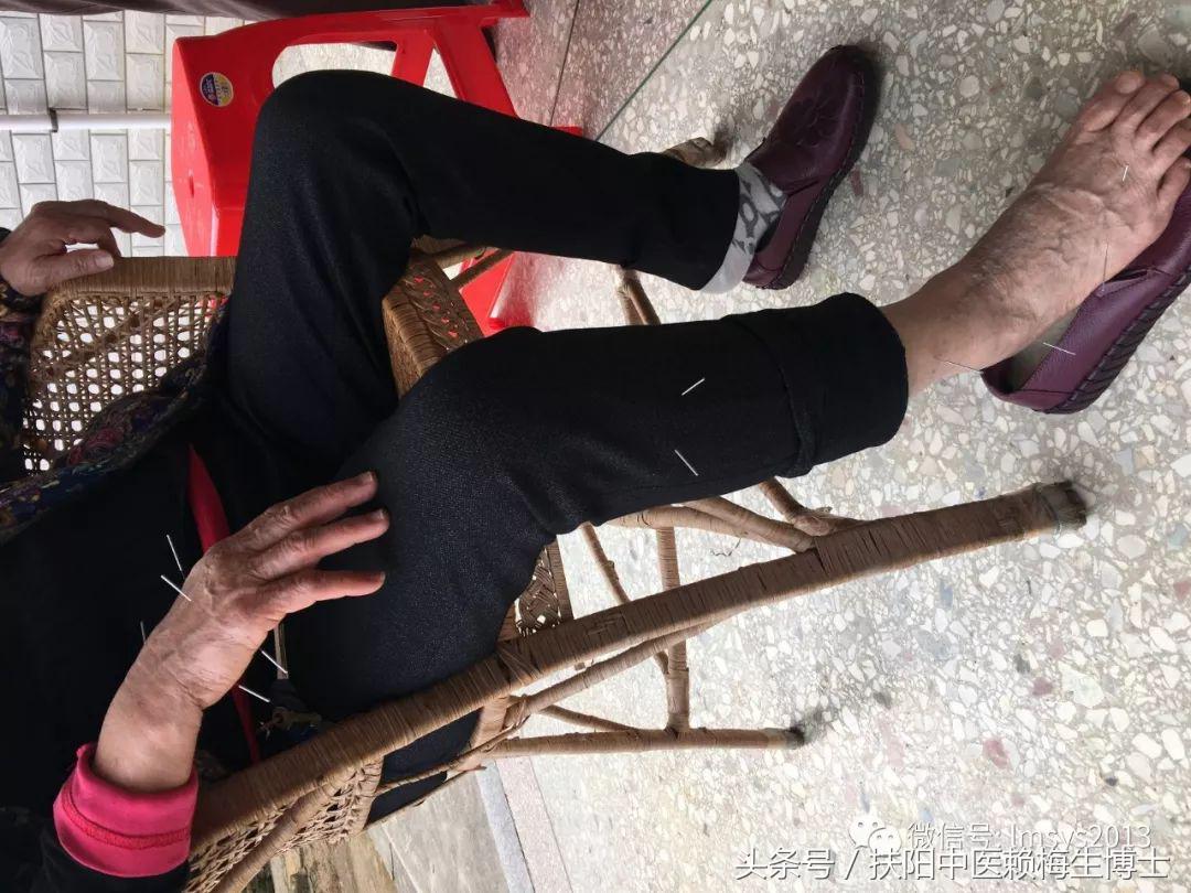 内针治疗带状疱疹剧烈疼痛4例分析