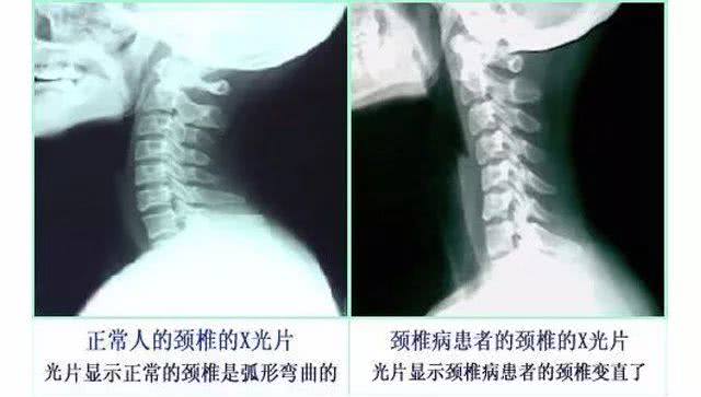 颈椎病引起的头晕该如何治疗,颈椎病引起的头晕该怎么锻炼康复