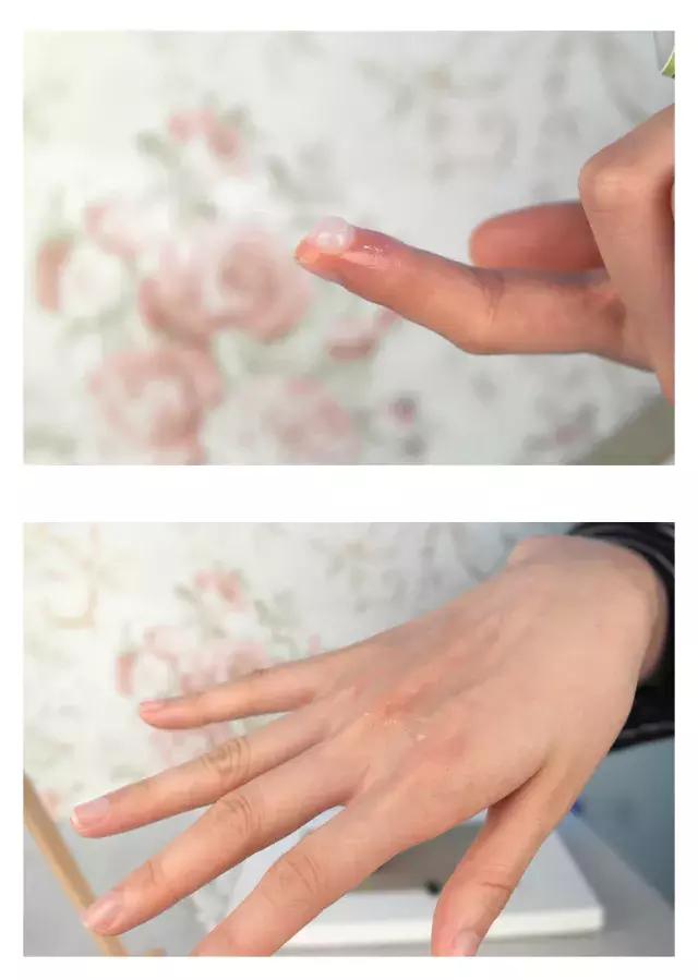 战痘经验,战痘成功的经历