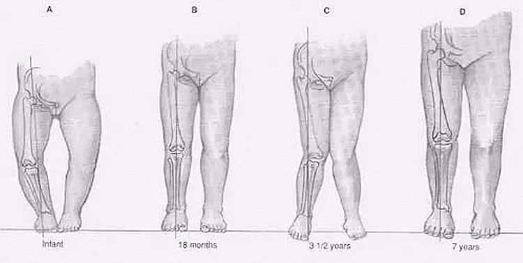 小孩发烧就惊厥怎么彻底治愈,治疗婴儿高温惊厥的偏方