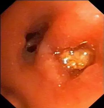 慢性支气管炎会导致咽喉有异物吗,反复咳嗽气管有痰不好怎么办