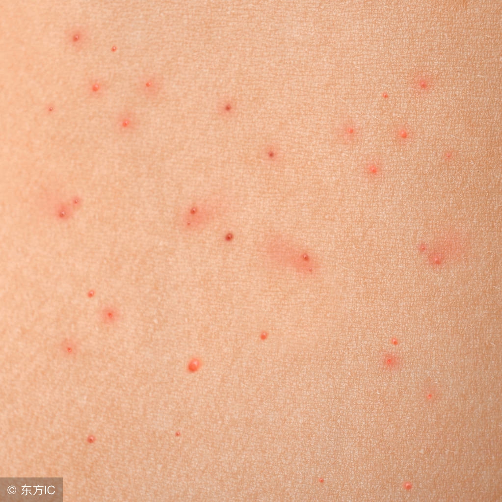 丘疹性荨麻疹症状是怎么引起的,丘疹性荨麻疹的症状与治疗方法